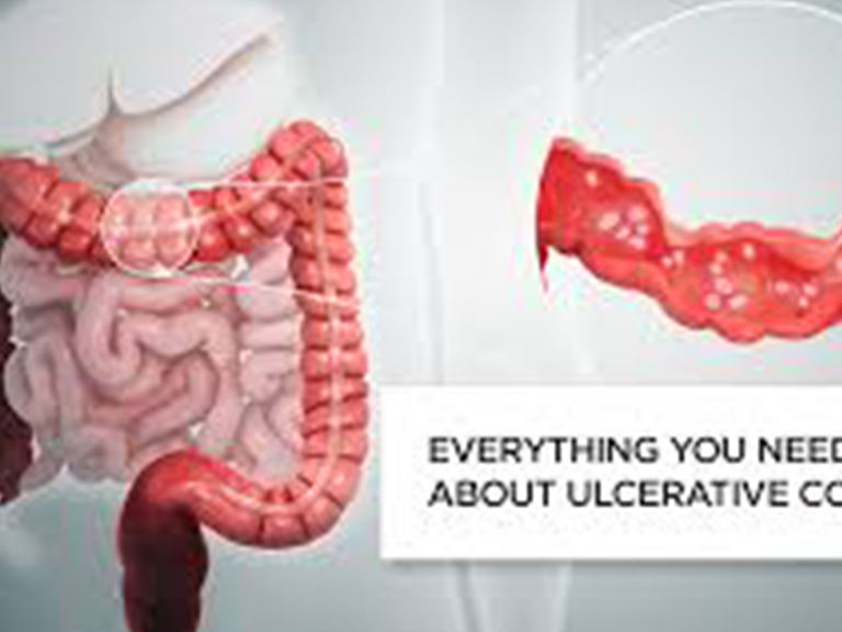 Ulcerative colitis