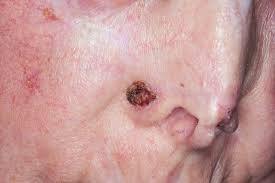 Cancer Skin Cancer