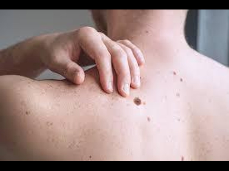 melanoma cancer