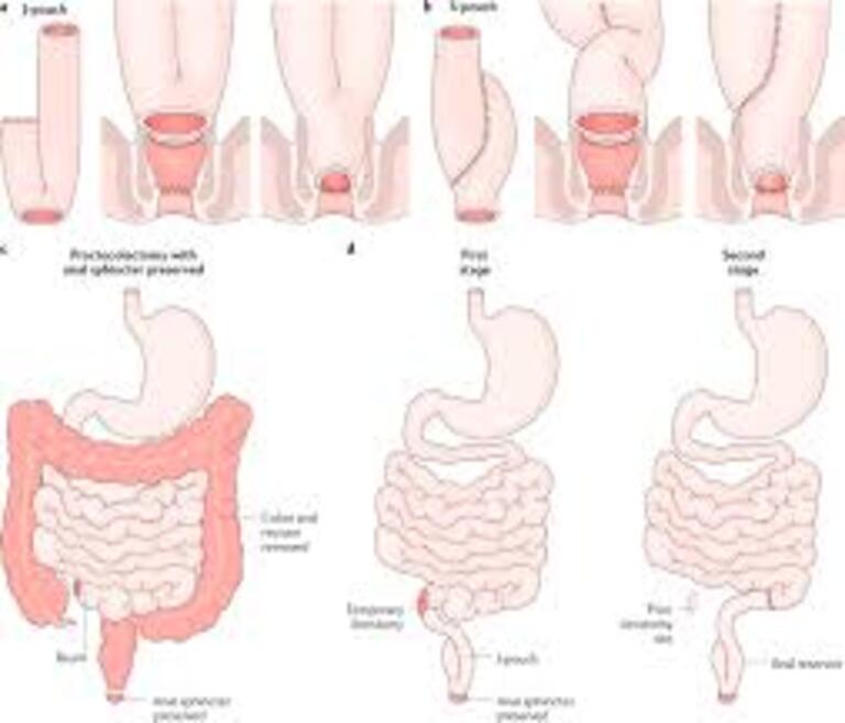 ulcerative colitis